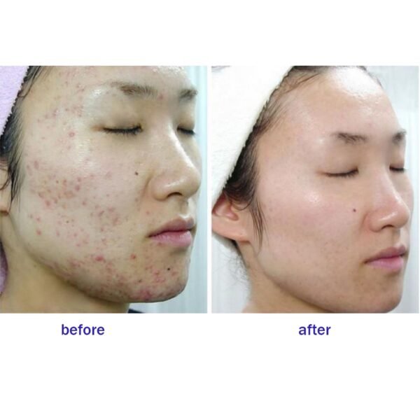 ISNTREE Hyper Acid 4 (AHA BHA PHA LAH) 30 Serum 20ml | Wash-off serum | Gentle Chemical Exfoliant | Korean Skincare - Image 7