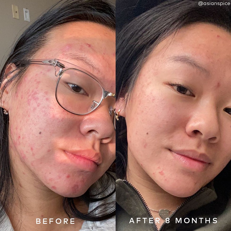 Good Molecules Discoloration Correcting Serum - Tranexamic Acid and Niacinamide Serum to Target Dark Spots and Hyperpigmentation - Skin Care for Face 75ml Big Bottle 6 Good Molecules Discoloration Correcting Serum - Tranexamic Acid and Niacinamide Serum to Target Dark Spots and Hyperpigmentation - Skin Care for Face 75ml Big Bottle - Image 6