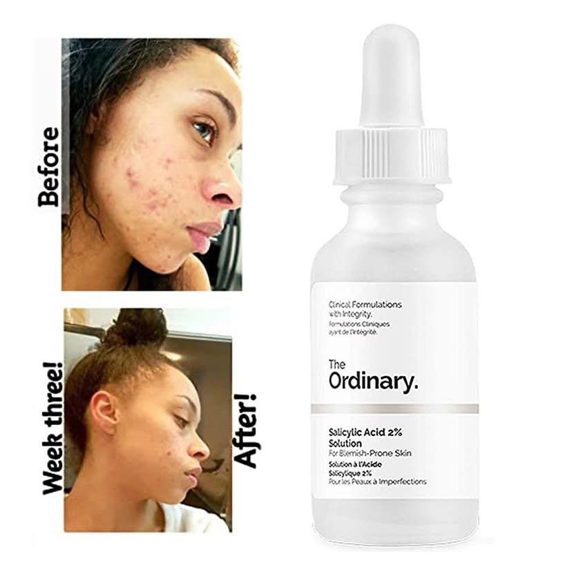 The Ordinary Salicylic Acid 2% Solution, Acne-Fighting Serum for Blemish-Prone Skin 5 The Ordinary Salicylic Acid 2% Solution, Acne-Fighting Serum for Blemish-Prone Skin - Image 5