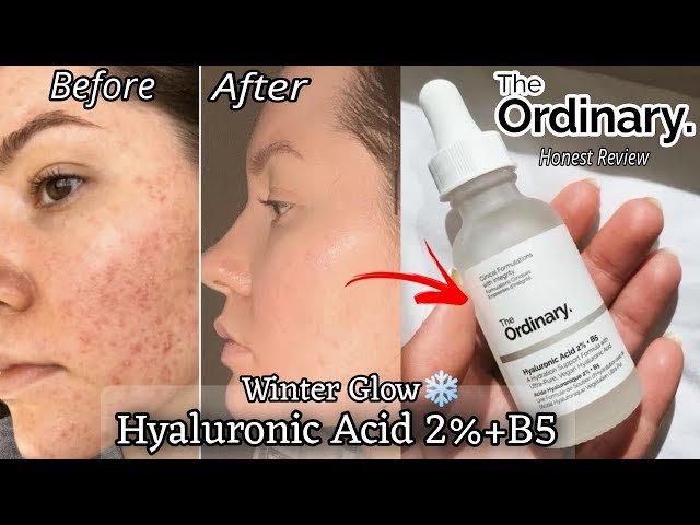 The Ordinary Hyaluronic Acid 2% + B5 (with Ceramides), Multi-Depth Hydration Serum for Plumper, Smoother Skin 6 The Ordinary Hyaluronic Acid 2% + B5 (with Ceramides), Multi-Depth Hydration Serum for Plumper, Smoother Skin - Image 6